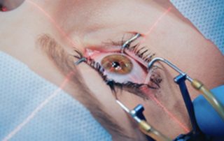 Chirurgie réfractive : quelles sont les différentes techniques pour corriger la vision ?